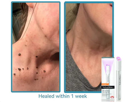 Viral Laser Eraser Pen